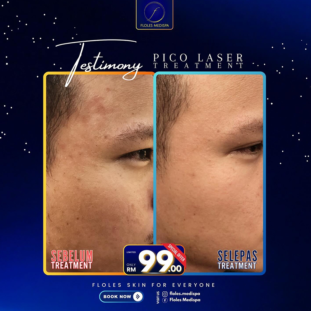 Pico Laser Before & After Gallery