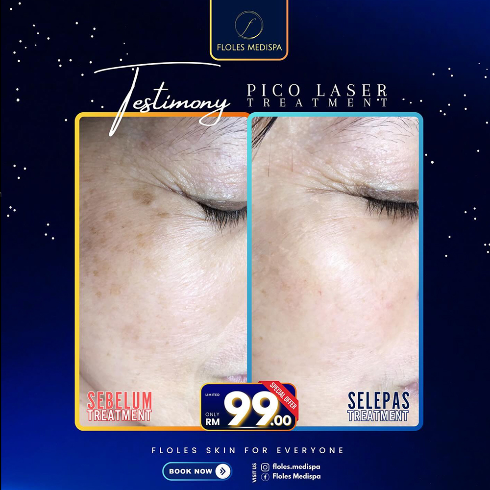 Pico Laser Before & After Gallery