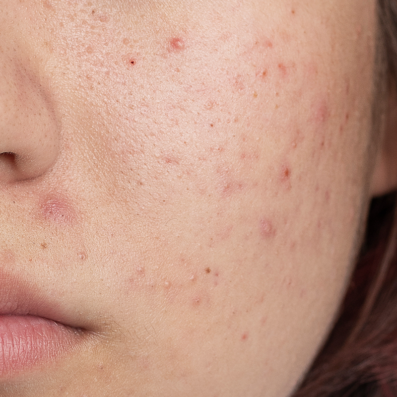 Skin concern acne scars