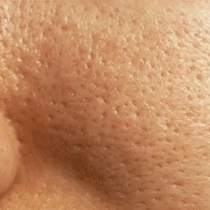Skin concern enlarged pores